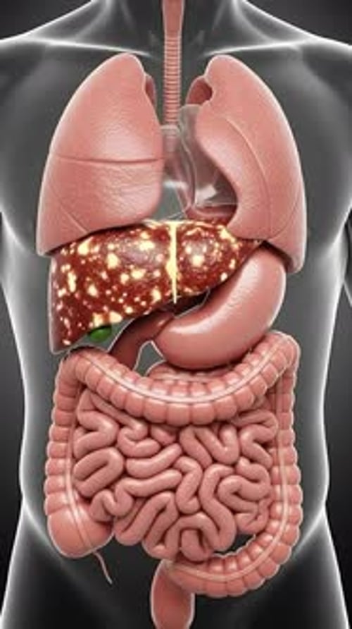 Fatty Liver - Hepatic Steatosis 3D Medical Animation | Manestream Den