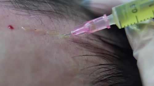 Macro shot of Hair mesotherapy procedure in the modern cosmetology clinic, plasma injectiions.