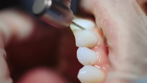 Close Up Patient Teeth Getting Dental Treatment at Dental Office Health Toothache Modern Clinic