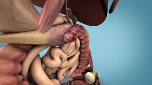 3D Medical Animation of Pancreatic Cancer Tumor