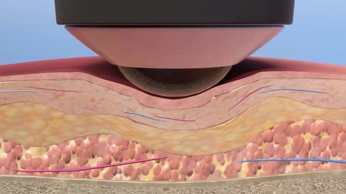 Medical Device Skin Treatment Showing Heat Application