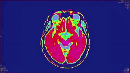 Magnetic Resonance Images of the Brain MRI of the Brain of a Patient with Multiple Vascular