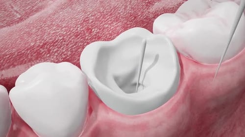 3D Dental Root Canal Treatment Process Animation
