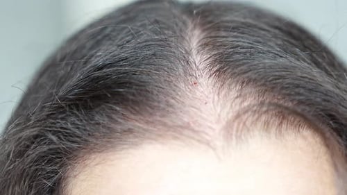 Closeup View of the Head with Traces of Blood From Injections After Mesotherapy Treatment of