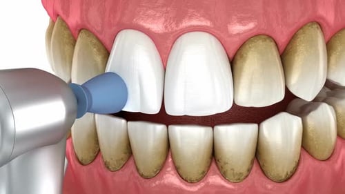 3D Animation of Dental Teeth Cleaning and Whitening