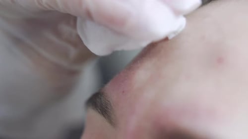 Forehead Injection Performed by Medical Professional