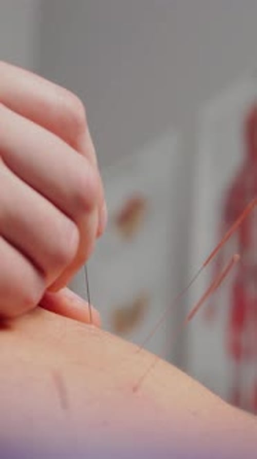 Akupunkturbehandlung Akupunkturtherapie In der Klinik führt der Arzt Akupunktur am Patienten durch