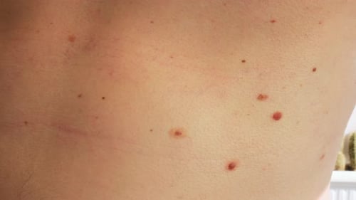 Hair Being Plucked From Back with Tweezers