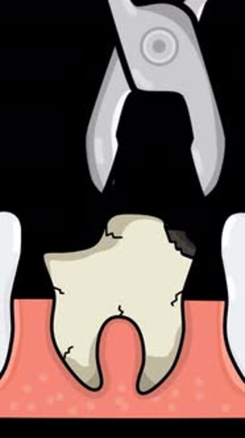 Tooth Extraction Dental Medical Animation On Alpha Channel Vertical