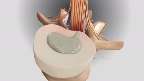 Detailed 3D anatomy of a herniated spinal disc