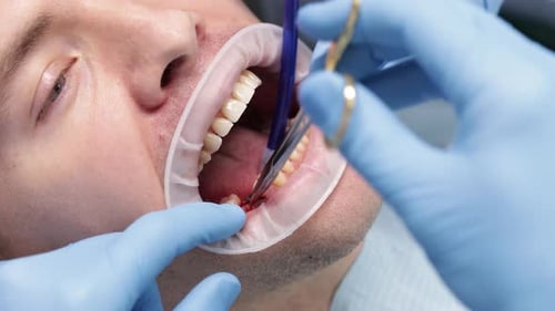 Suturing Around Healing Abutment Often Referred to As a Healing Cap or Gingival Former Dental