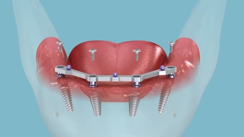 3D Dental Implant Supported Dentures Installation Process