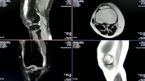 MRI Scan Images Revealing Detailed Knee Joint Anatomy and Conditions