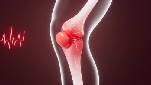 Human kneecap model, arthrophlogosis, joint swelling, joint pain, 3d rendering.