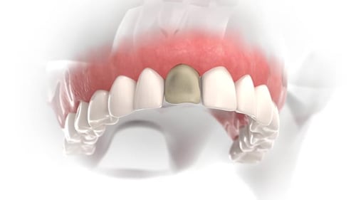 Dental Crown Replacement Procedure Animation with Diseased Tooth