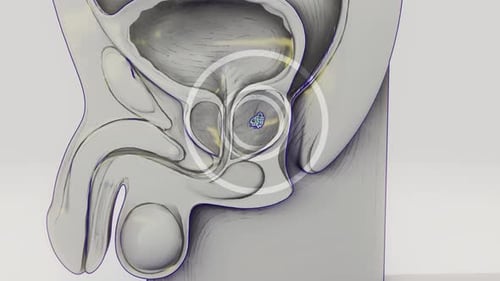 Conceptual animation of prostate cancer