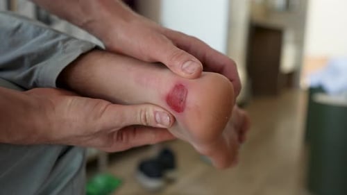 Man Inspects Blister on Heel of Foot