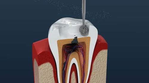 Root canal treatment process. 3D Animation.
