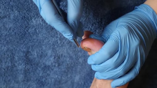 Examining a Foot with Blue Medical Gloves