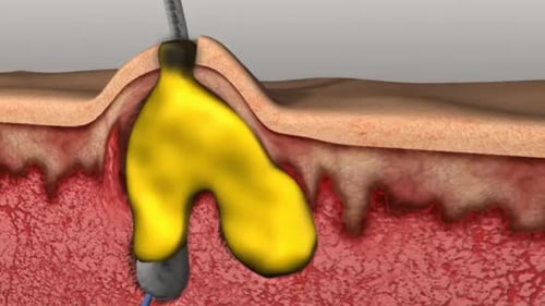 Close-up view of a hair follicle with a yellow sebum build-up