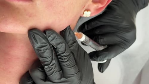 Aesthetic Medicine Closeup of Collagen Biorevitalization Treatment with Cannula Injection Into