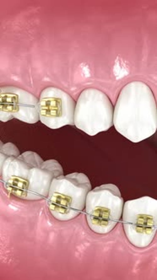 3D Animation of Dental Braces Application Process