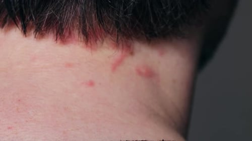 Man Scratches Neck Bitten By a Bedbug on a White Background Closeup Skin Health Problem Allergy Red
