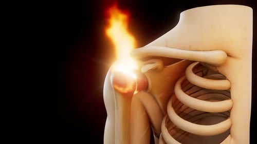 3D Animation of Shoulder Joint Pain and Inflammation