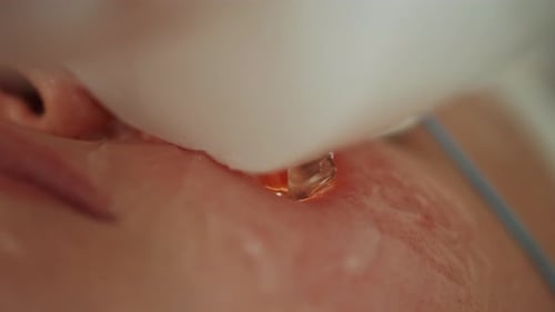Vidéo macro sur l'élimination des taches pigmentaires en cosmétologie