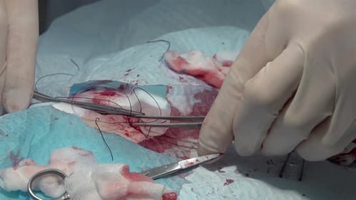 Doctor Suturing Wound with Needle and Self Dissolving Thread During a Surgery