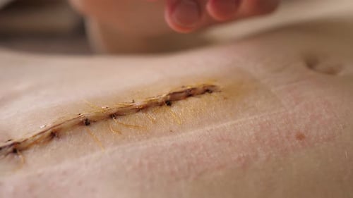 Abdomen of Young Girl Closeup Video of the Long Scar Above Navel After Abdominal Surgery for