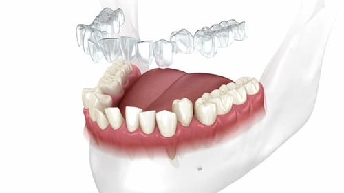 3D Animation of Clear Dental Aligner Placement and Removal