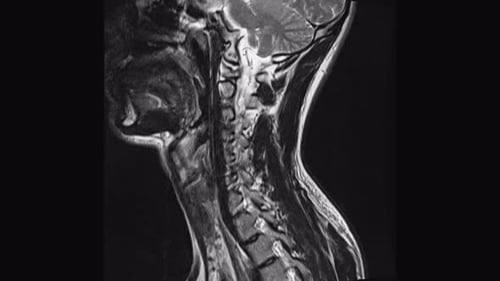Magnetic Resonance Images ( MRI ) of Cervical Spine Sagittal C5 C6 C7 Injured Disc Disease