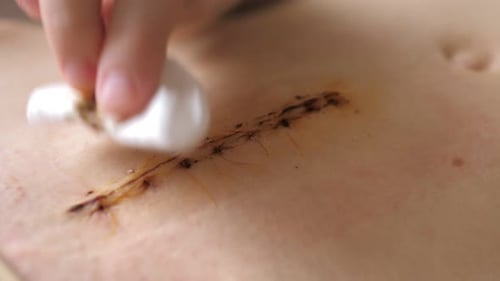 Abdomen of Young Girl Closeup Video of the Long Scar Above Navel After Abdominal Surgery for
