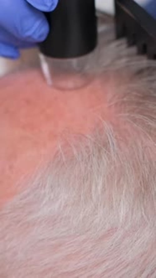 Doctor Examining Scalp with Microscope for Hair Loss