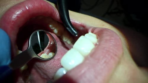 Dental Care Extreme Close Up Macro Video Dentist Treat Patient Teeth Orthodontist Works with