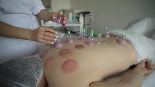 Cupping Therapy Treatment on Woman's Back in Clinic