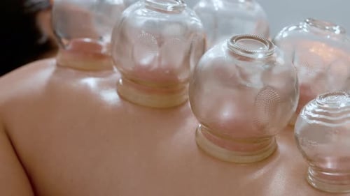 Woman Receiving Cupping Therapy Treatment on Her Back