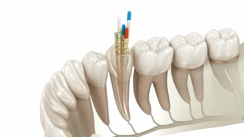 Endodontic root canal treatment process