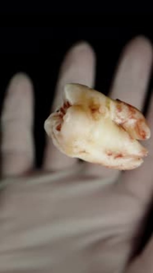 Vertical video. Knocked-out Human Tooth Spins and Falls Down, Caught by a Hand in a White Glove,