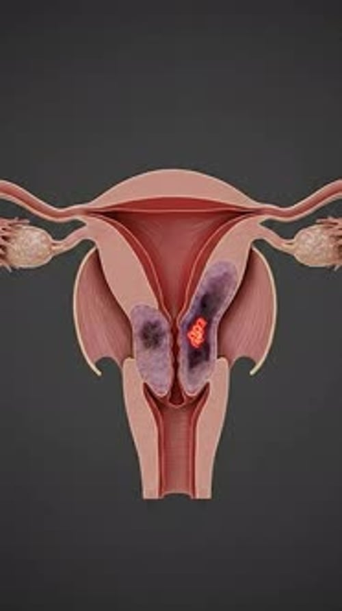 Medical Animation of Uterus with Cancerous Cell Growth