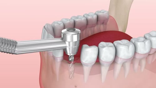 Proceso de instalación de implantes dentales, animación 3D médicamente precisa