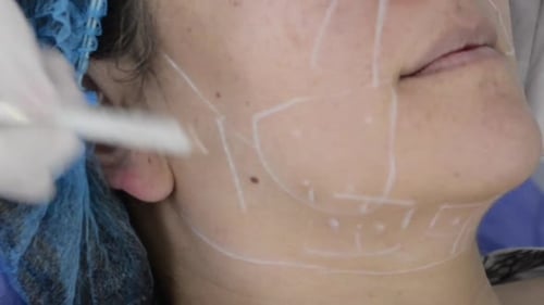 Doctor trace marks with white pen on patients face. Aesthetic procedure plastic surgery