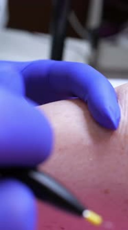 A close-up of a hair removal electrolysis treatment