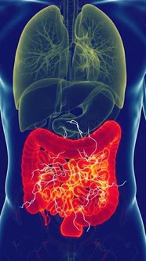 Microbiome Gut Inflammation - Intestinal Thermal Scan 3d Medical Animation | Manestream Den