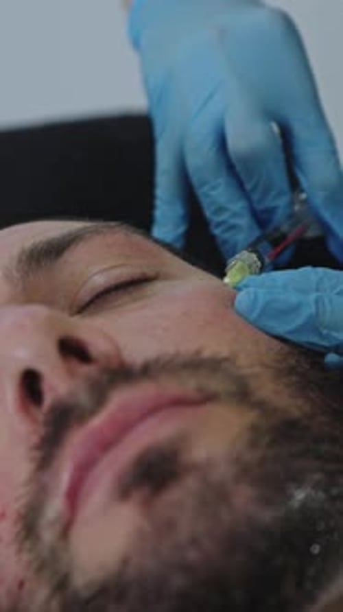 Medical Aesthetic Procedure: Close-Up Facial Polynucleotides Injection on Male Patient