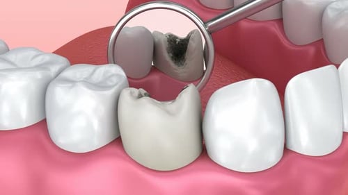 Inspección de dientes con caries. Animación 3D de dientes con precisión médica