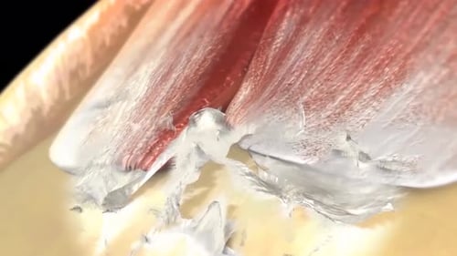 Rotator Cuff Tear Medical Animation with Tendon Detail