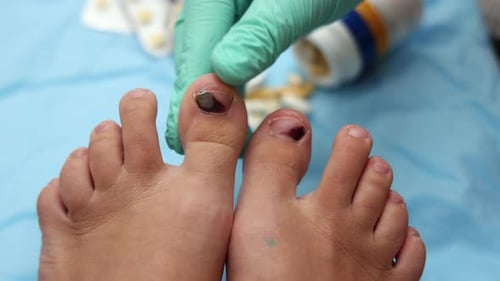 Damaged Toenails Examined in Medical Setting
