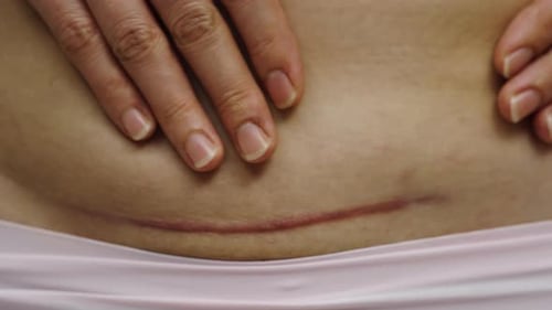 close up belly of woman with a c-section scar of caesarean